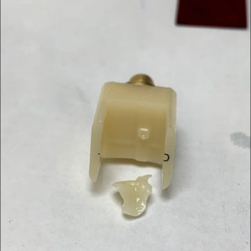 Tooth Crowns in Midwood, NY